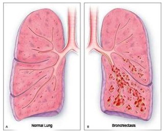 Lungs.jpg