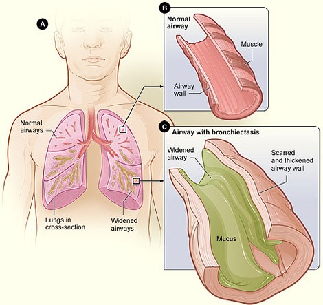 what is worng with my lungs replacement image.jpg